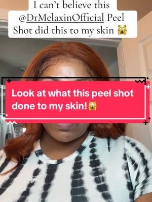 I cannot believe this happened when I used @Dr Melaxin Official Peel Shot on my skin! My skin feels smooth like a baby! I love how soft and glowy my skin is after using this product! Highly recommend! Thank me later! Grab yours today!!✨😍 #drmelaxinpeelshot #peelshotglow #skincarerecommendations #skincareroutinetips #tiktokshopspringglowup
