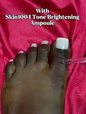 Fade dark toes in a week with Skin1004 Tone Brightening Ampoule @SKIN1004 US #goviralwithskin1004challenge #skin1004white #skin1004 #centella #Tiktokmademebuyit #koreanskincare #kbeauty #skincareroutines