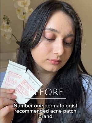 @Neutrogena #ad #neutrogenapartner #neutrogena #pimplepatch