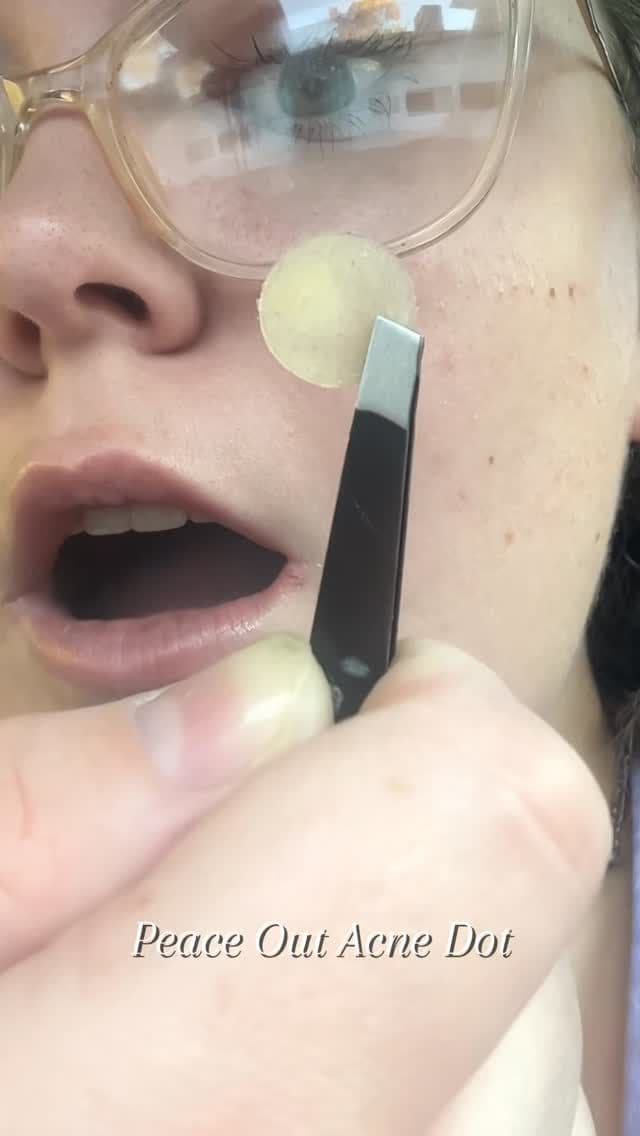 Proof it’s doing its job🤭 @peaceoutskincare available at @sephora #showusyourgunk #peaceoutskincare #acnedots #ad #peac