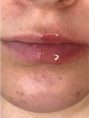 I feel like this @Laka lip plumper speaks for itself I mean 👀 #tiktokmademebuyit #dealdrops #kbeauty #lipplumper