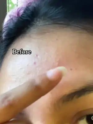 ✨ “Dark spots on my forehead? Not anymore! 🌟 Loving how Skin1004 Tone Brightening Ampoule fades hyperpigmentation and evens out my skin tone. 💛 #goviralwithskin1004challenge #skin1004white #centella #tiktokmademebuyit #kbeauty @SKIN1004 US @skin1004_influencers