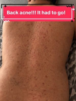 If you’re dealing with body acne, you need products that actually work together. The Some By Mi set uses AHA, BHA, and PHA to exfoliate, clear breakouts, and smooth the skin over time. This is what consistency looks like. #TikTokShopStockUp #backacne #skincareroutine #bodyacne #clearskinjourny