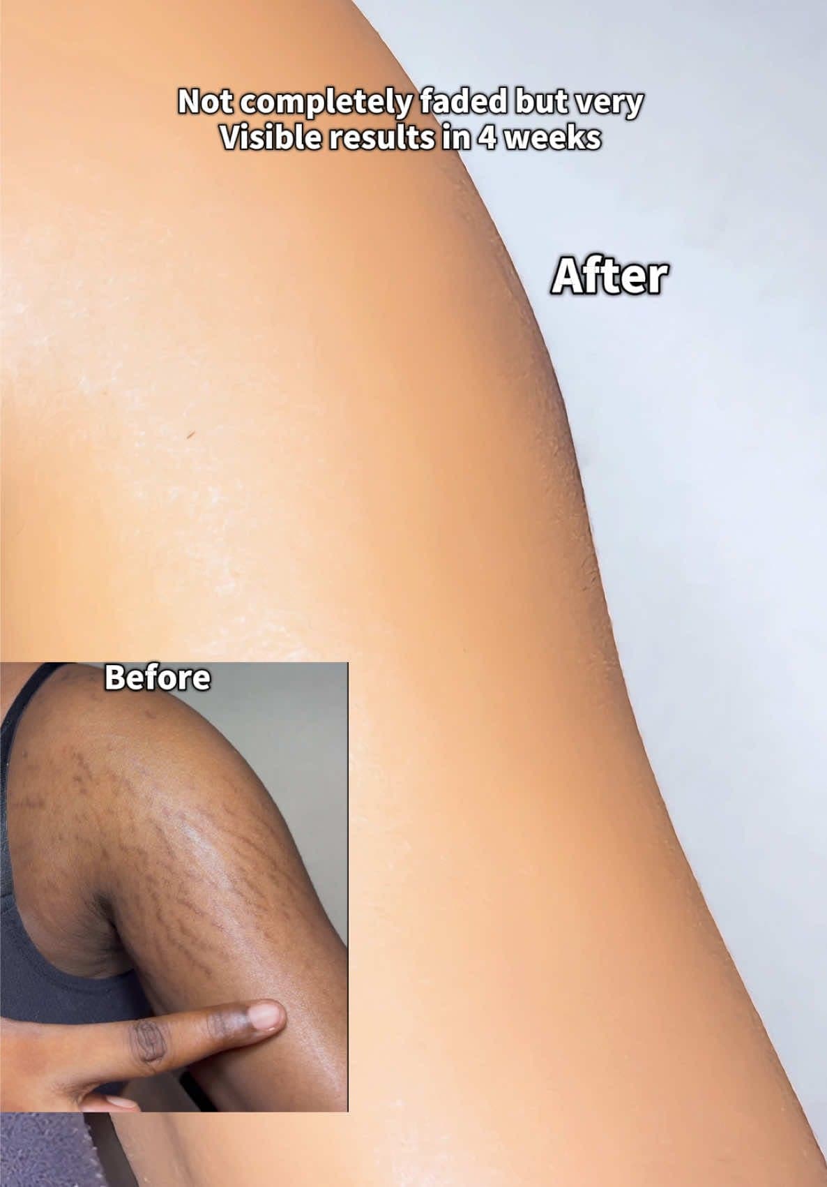 ✨ HOW TO USE RETINAL TO REMOVE STRETCH MARKS ✨ Retinal will help improve the appearance of stretch marks by encouraging skin cell turnover and supporting collagen production. 🤍 1️⃣ Start with a low-strength retinal, 2–3 nights a week like the one I used from@KSECRET GLOBAL 2️⃣ Apply a small amount to clean, completely dry skin. 3️⃣ Gently massage it into the stretch-marked area. 4️⃣ Follow with a nourishing moisturizer to reduce dryness. 5️⃣ Gradually increase frequency as your skin gets used to it. 6️⃣ Be consistent — results can take several weeks to months. ✨ Save this for your stretch-mark care routine! 💕 #streatchmarks #retinal #seoul1988 #koreanskincare #ksecret